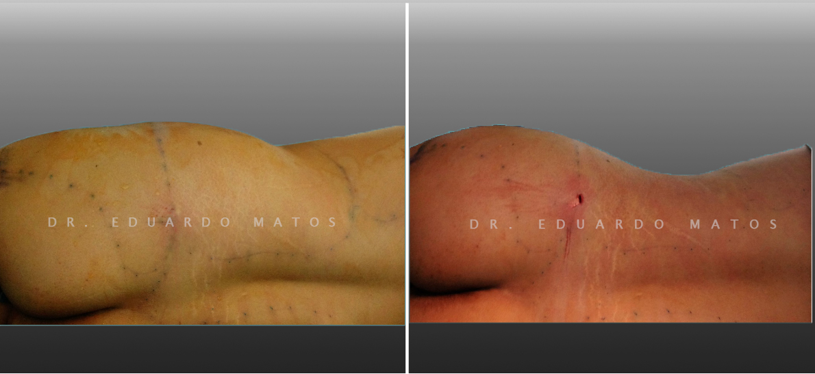 Lipoaspiração e Lipoescultura - Dr. Eduardo Matos. BBL Aumento de nádegas com gordura