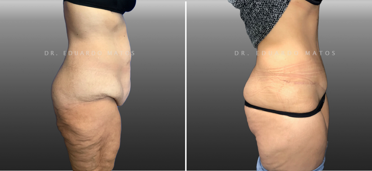 Lipobodylift - Dr. Eduardo Matos Perder Barriga no Homem