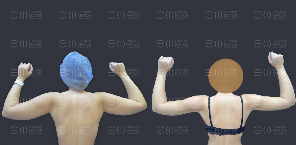 Lipoaspiração de braços cirurgia plastica lipo aspiração