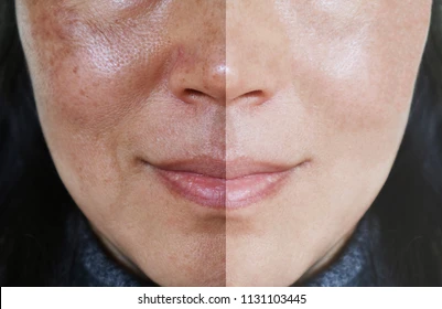 Melasma manchas na pele manchas escuras na pele